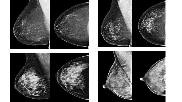 Oncoplasty